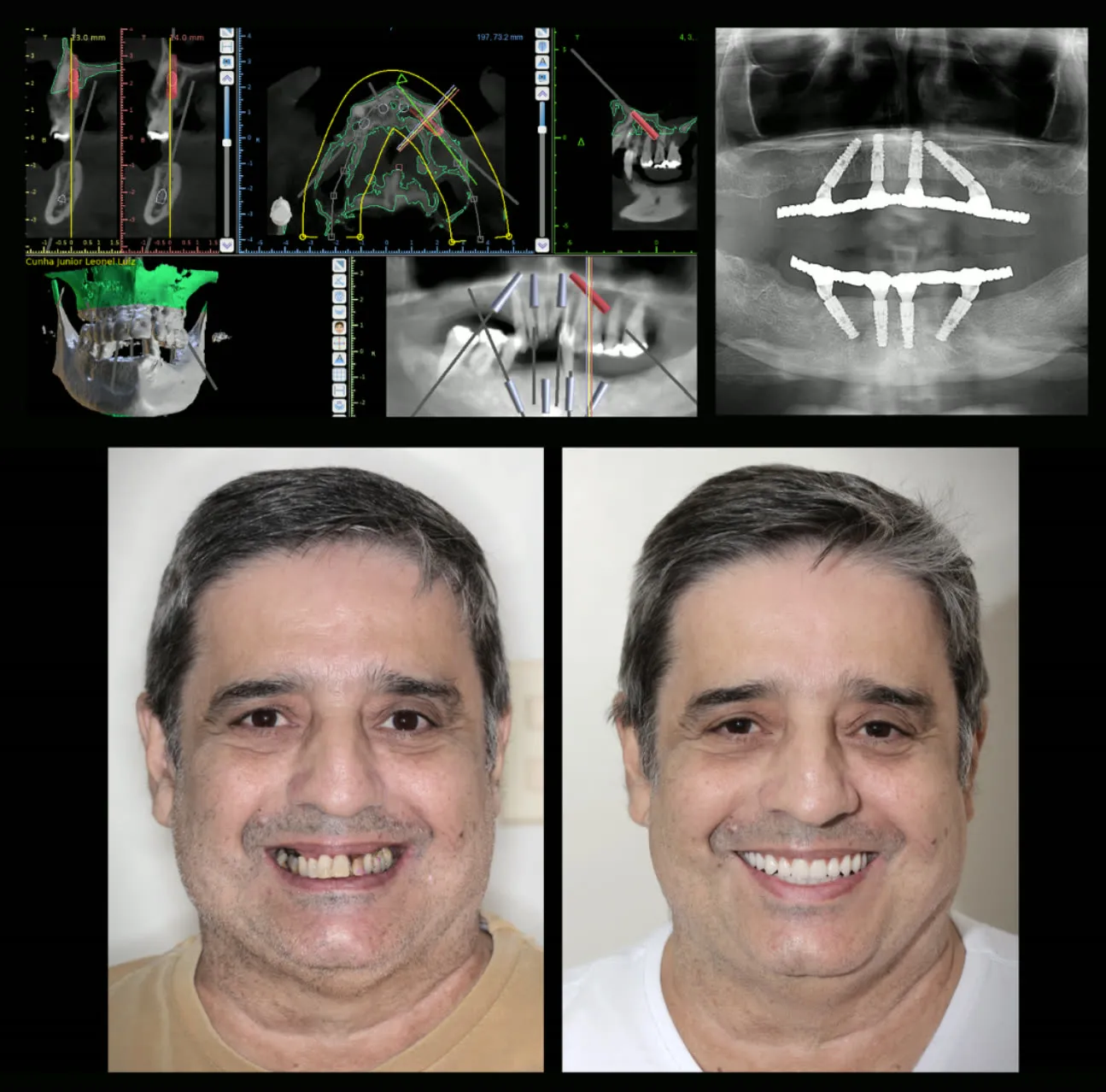 Antes e depois: All-on-4 com planejamento digital