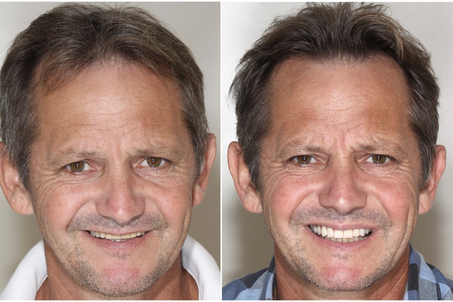 Antes e depois: homem reabilitado com dentes fixos sobre implantes