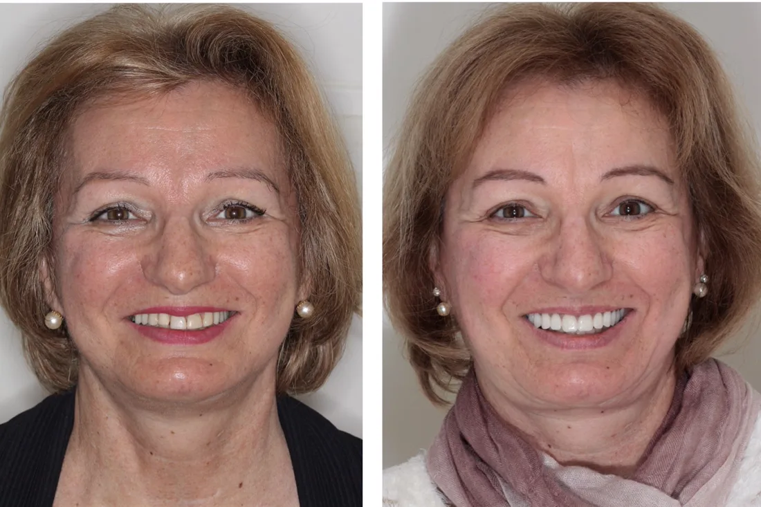 Antes e depois: paciente reabilitada com prótese fixa sobre implantes
