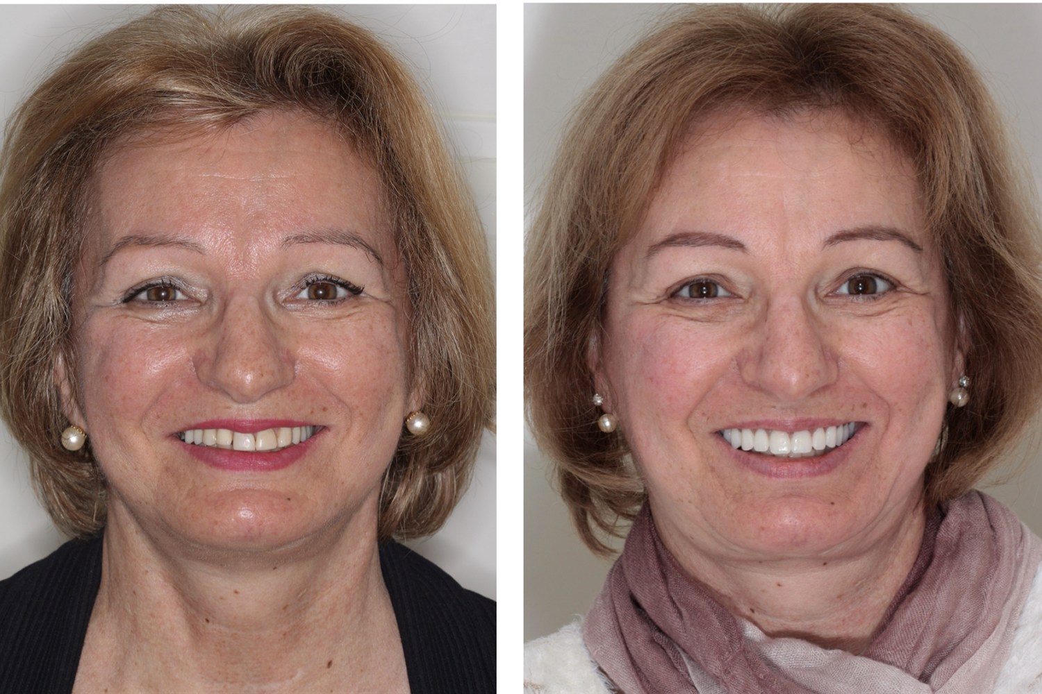 Antes e depois: paciente reabilitada com prótese fixa sobre implantes