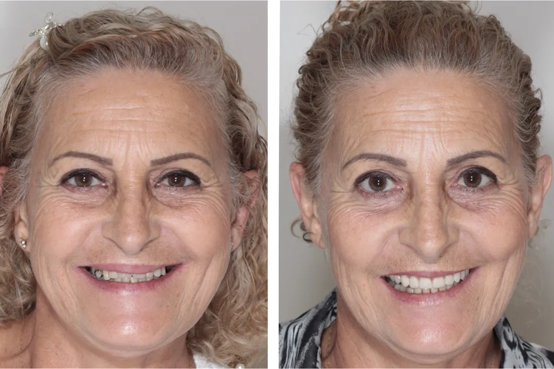 Antes e depois: reabilitação completa com dentes fixos