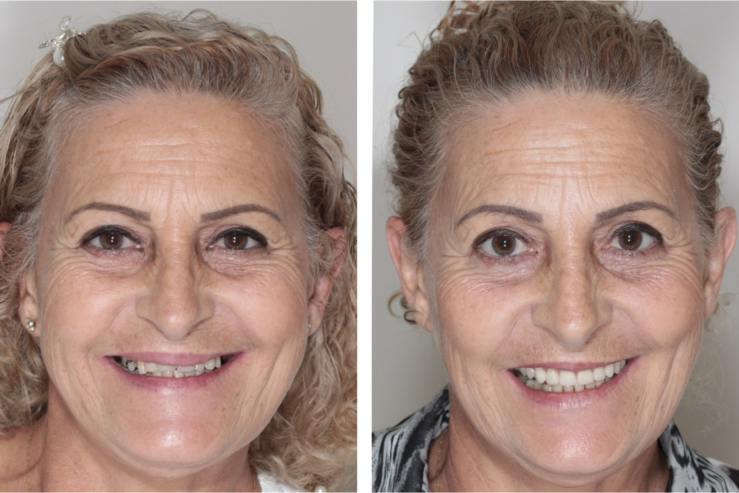 Antes e depois: reabilitação completa com dentes fixos