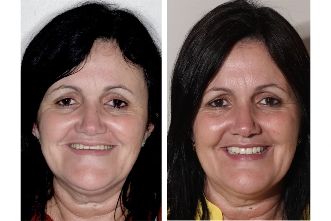 Antes e depois: sorriso devolvido com dentes fixos sobre implantes