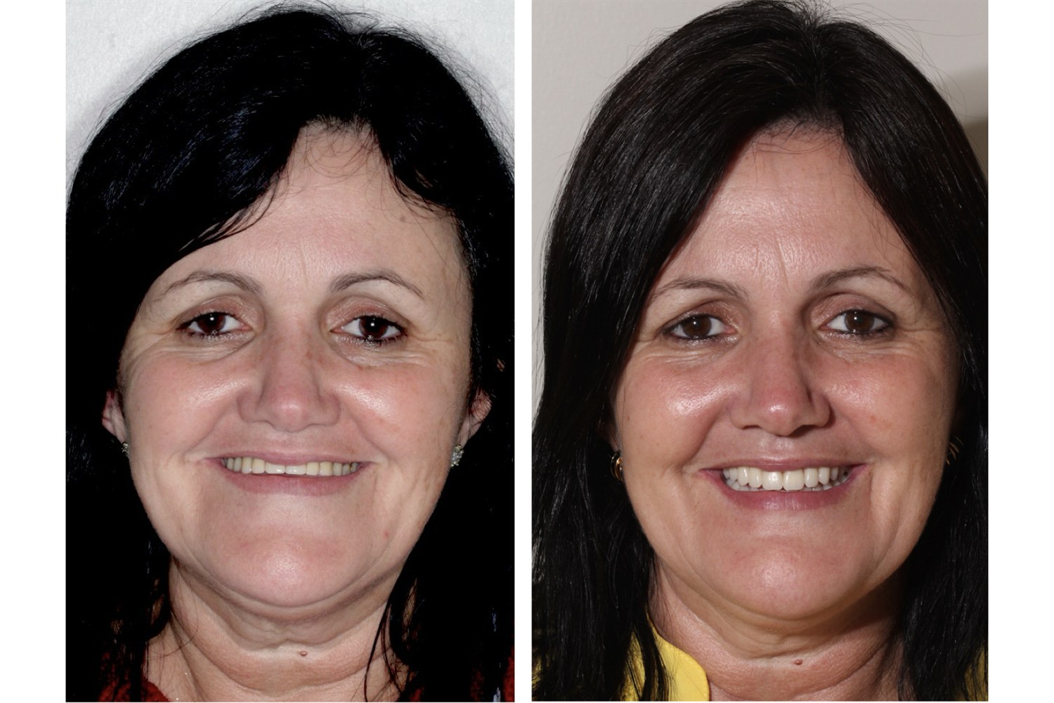 Antes e depois: sorriso devolvido com dentes fixos sobre implantes