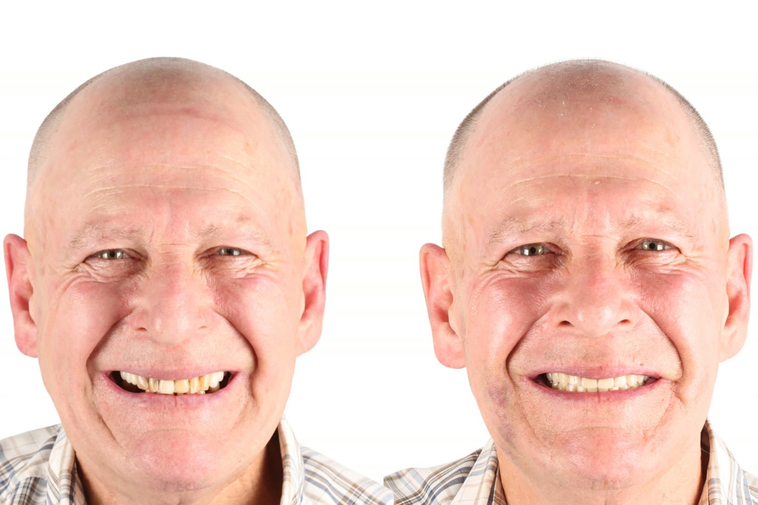 Antes e depois: paciente que veio do Canadá para o Brasil