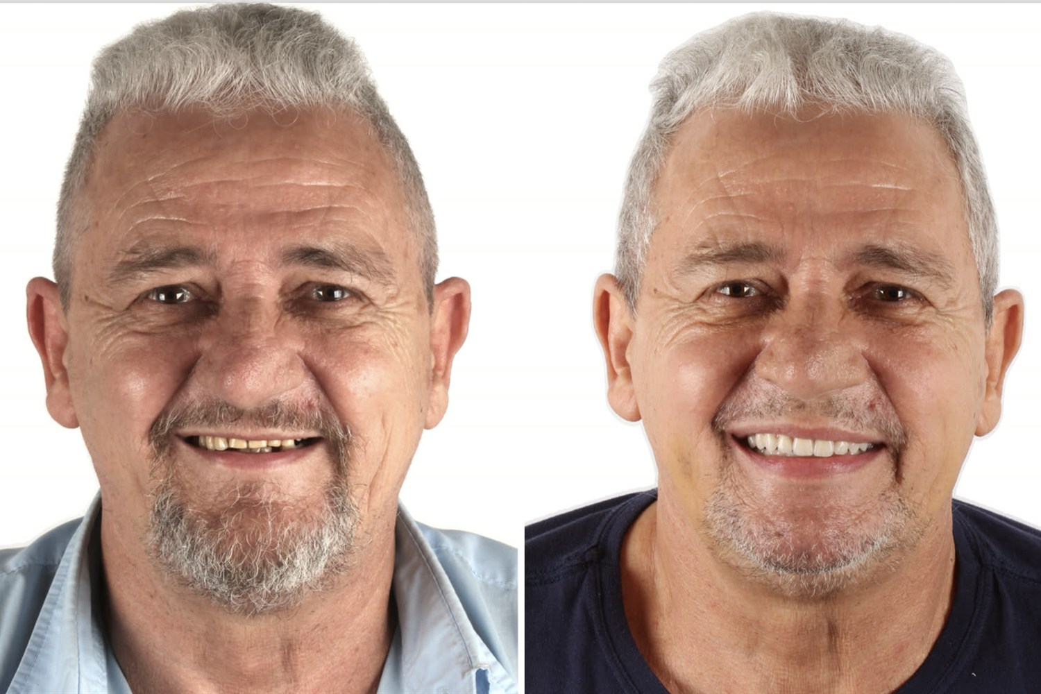 Antes e depois: caso reabilitado com a abordagem FaceFirst e implantes zigomáticos