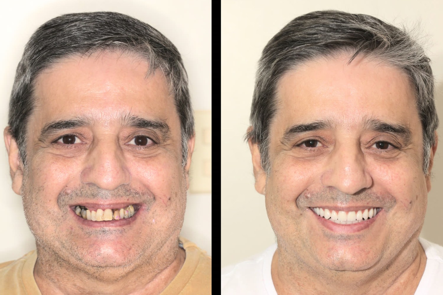 Antes e depois: reabilitação com dentes fixos sobre implantes