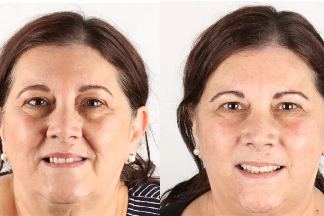 Antes e depois: paciente que veio dos EUA para o Brasil