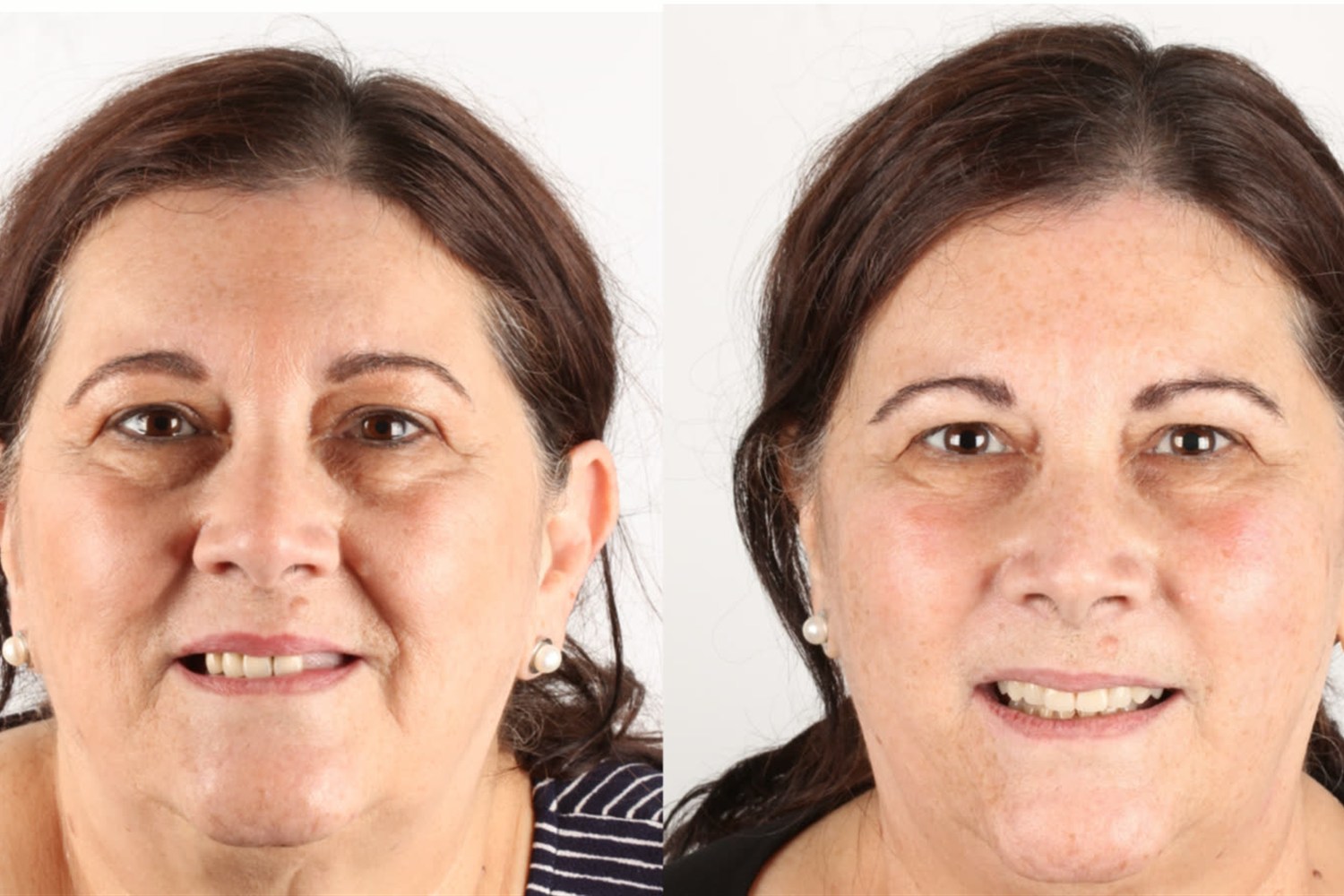 Antes e depois: paciente que veio dos EUA para o Brasil