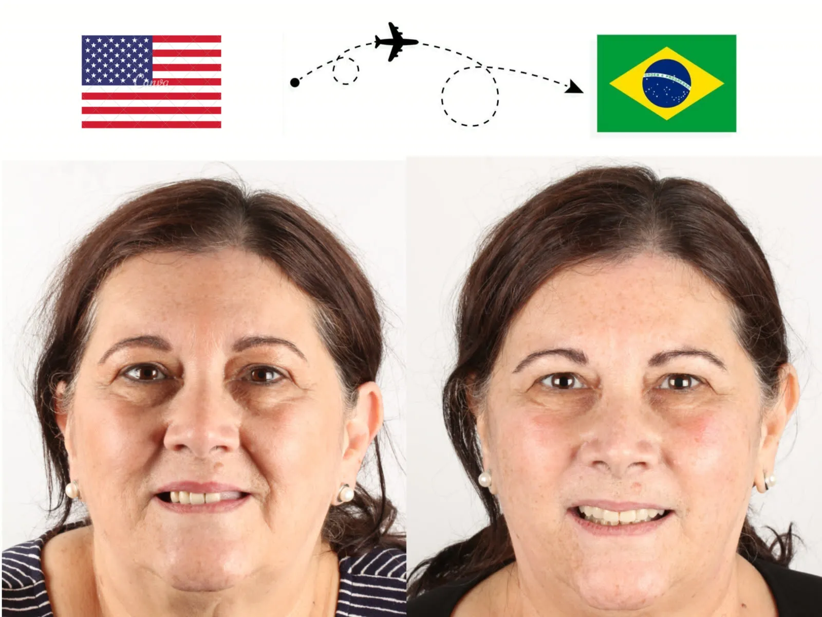 Antes e depois: paciente que veio dos EUA para o Brasil