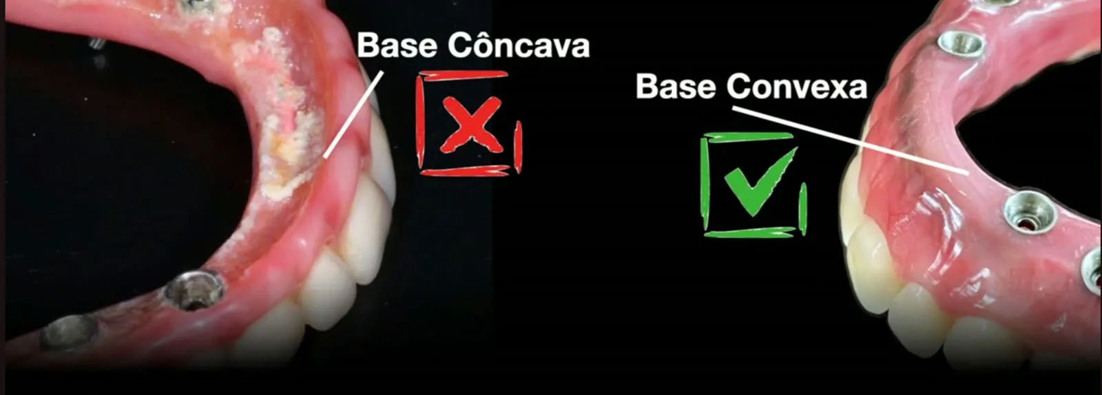 Diferença entre prótese de base côncava e base convexa