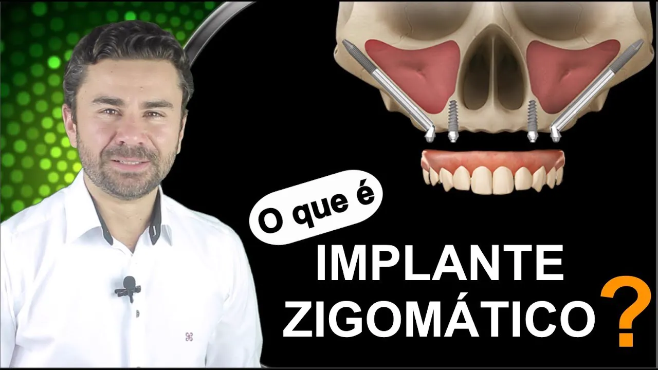 Vídeo: o que é um implante zigomático — Dr. Fernando Giovanella